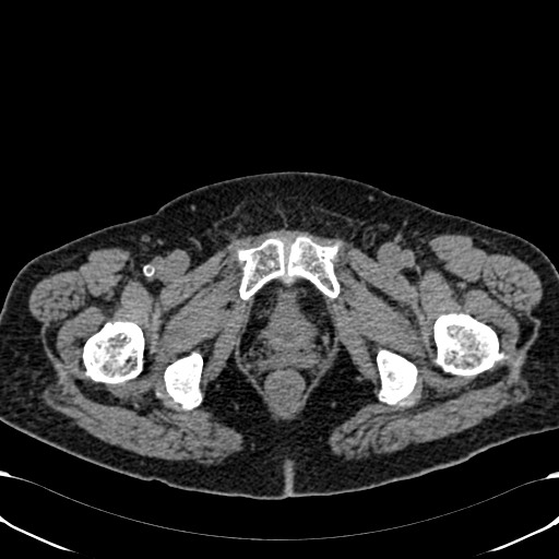File:Acute appendicitis (Radiopaedia 58627-65818 Axial non-contrast 89).jpg