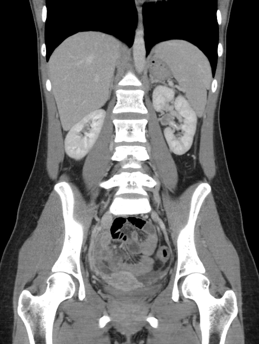 Acute appendicitis (Radiopaedia 62608-70901 Coronal C+ portal venous phase 32).jpg