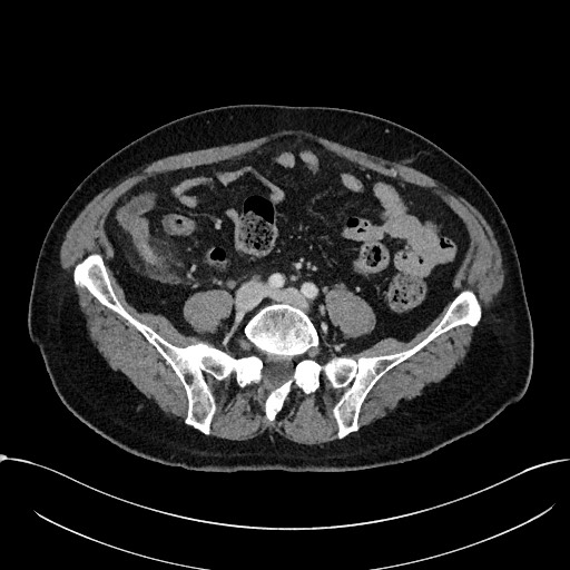 Acute appendicitis - large appendicoliths (Radiopaedia 61805-69820 Axial C+ portal venous phase 86).jpg