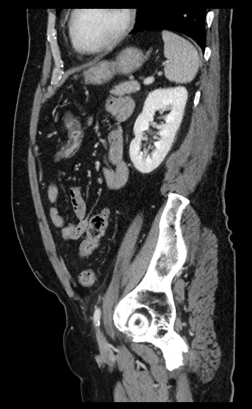Acute appendicitis - large appendicoliths (Radiopaedia 61805-69820 Sagittal C+ portal venous phase 34).jpg
