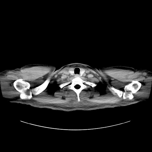 Acute appendicitis and COVID 19 pneumonia (Radiopaedia 76604-88380 Axial non-contrast 3).jpg