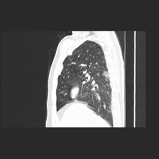 File:Acute appendicitis and COVID 19 pneumonia (Radiopaedia 76604-88380 Sagittal lung window 31).jpg