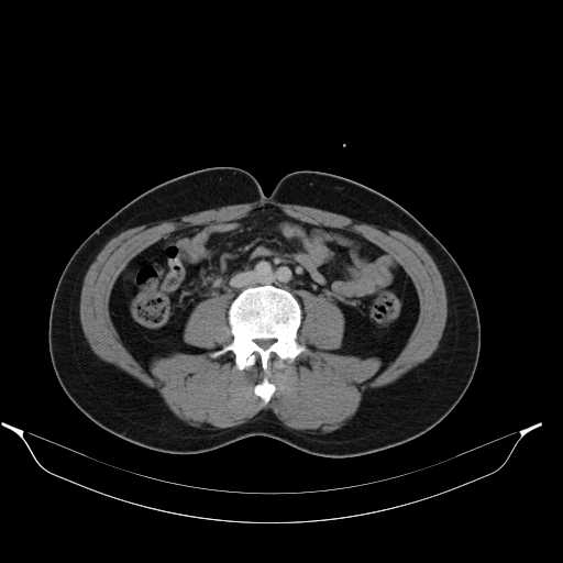 File:Acute appendicitis with appendicoliths (Radiopaedia 21148-21062 Axial C+ portal venous phase 3).jpg