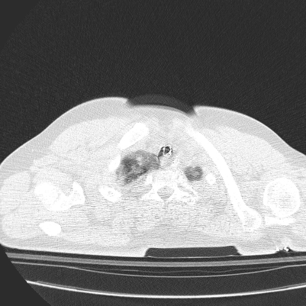 Acute aspiration pneumonitis (Radiopaedia 33605-34703 Axial lung window 14).jpg