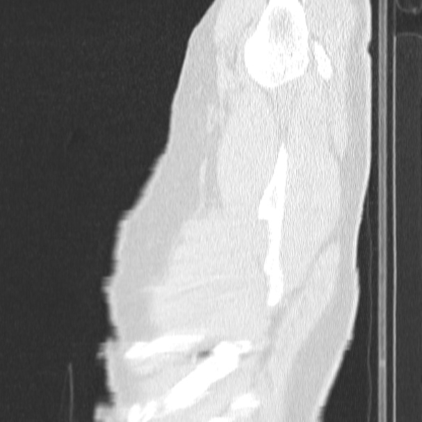 Acute aspiration pneumonitis (Radiopaedia 33605-34703 Sagittal lung window 6).jpg