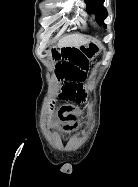 Acute bowel ischemia (Radiopaedia 87695-104114 Coronal C+ portal venous phase 86).jpg