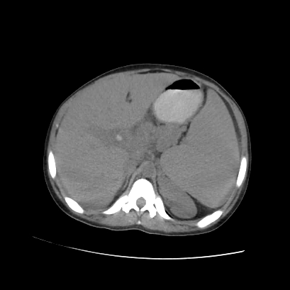 File:Acute calculous cholecystitis in patient with osteopetrosis (Radiopaedia 77871-90159 Axial non-contrast 28).jpg