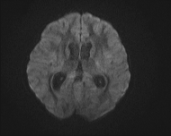 File:Acute cerebellar ataxia (Radiopaedia 61487-69446 Axial DWI 12).jpg