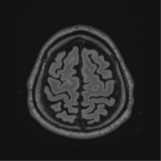 Acute disseminated encephalomyelitis (ADEM)- Anti-NMDA receptor encephalitis (Radiopaedia 54920-61201 Axial FLAIR 60).png