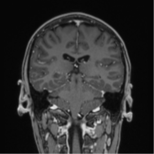 Acute disseminated encephalomyelitis (ADEM) (Radiopaedia 65319-74349 Coronal T1 C+ 15).png