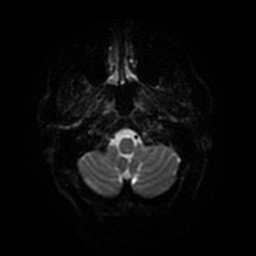 Acute internal carotid artery dissection (Radiopaedia 53541-59632 Axial DWI 35).jpg