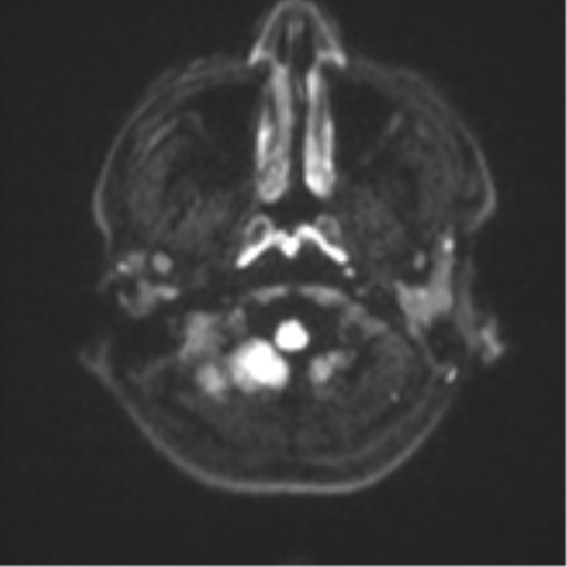 Acute left middle cerebral artery territory infarct with clot retrieval (Radiopaedia 47732-52433 Axial DWI 32).png