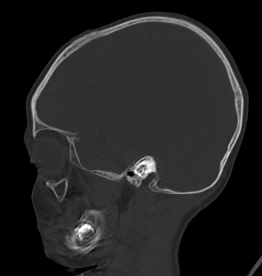 Acute mastoiditis (Radiopaedia 82678-96881 Sagittal bone window 18).jpg