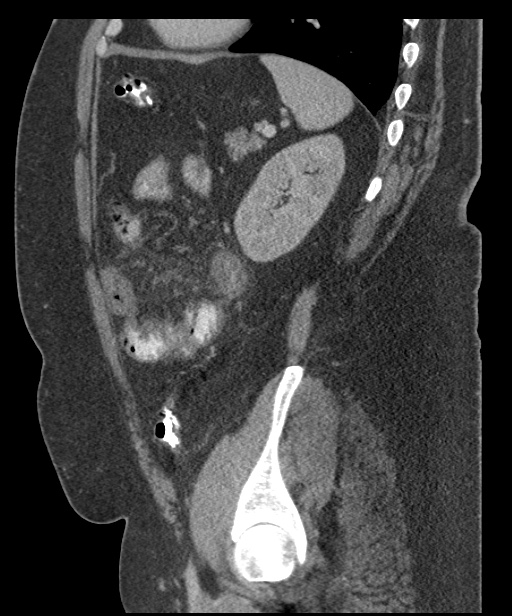 Acute mesenteric venous ischemia (Radiopaedia 46041-50383 Sagittal C+ portal venous phase 86).jpg