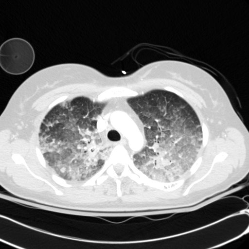 Acute myocardial infarction in CT (Radiopaedia 39947-42415 Axial lung window 34).jpg