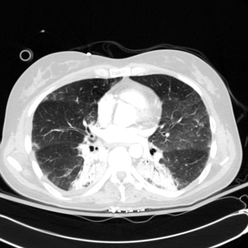 Acute myocardial infarction in CT (Radiopaedia 39947-42415 Axial lung window 71).jpg