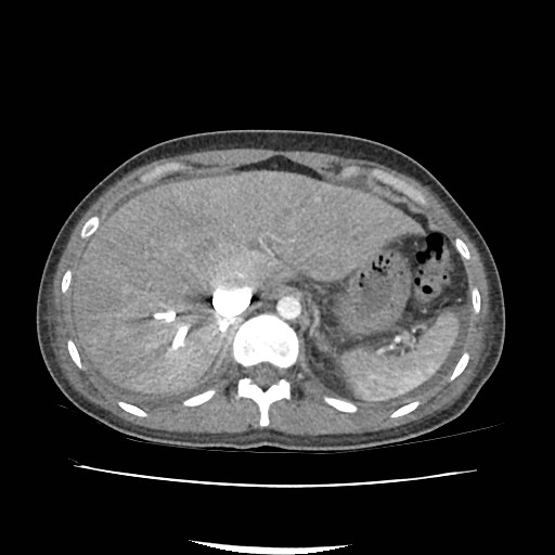 File:Acute myocarditis (Radiopaedia 55988-62613 Axial C+ portal venous phase 17).jpg