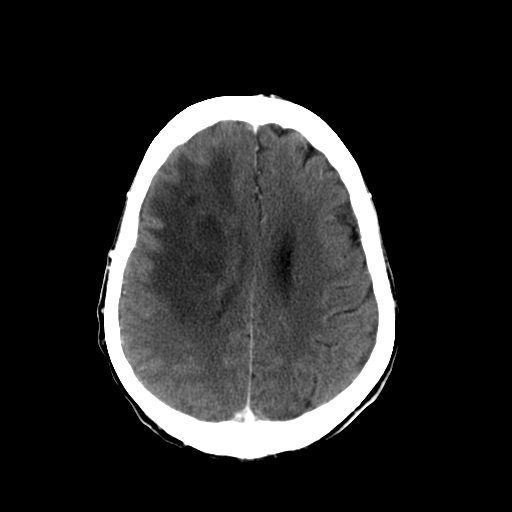 File:Acute necrotizing toxoplasma encephalitis (Radiopaedia 10683-11150 C+ arterial phase 11).jpg