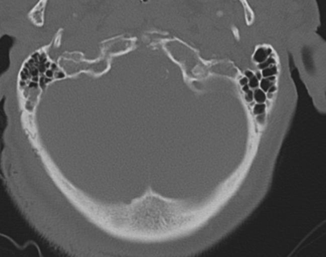 Acute on chronic subdural hematoma and thoracic vertebral injury in a multitrauma patient (Radiopaedia 31698-32619 Axial bone window 8).jpg