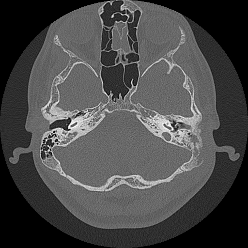 Acute otomastoiditis and Bezold abscess (Radiopaedia 88184-104786 Axial bone window 31).jpg