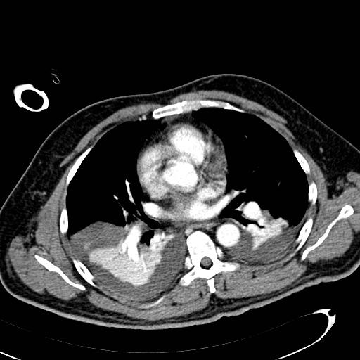 File:Acute pancreatic necrosis (Radiopaedia 13560-13486 Axial C+ portal venous phase 2).jpg