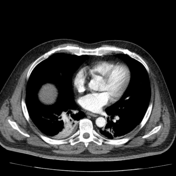 Acute pancreatitis (Radiopaedia 26663-26813 Axial C+ arterial phase 6).jpg