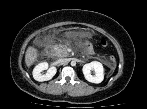 Acute pancreatitis (Radiopaedia 69236-79012 Axial C+ portal venous phase 37).jpg