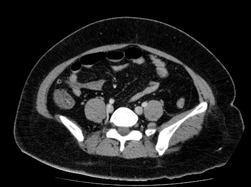 Acute pancreatitis (Radiopaedia 69236-79012 Axial C+ portal venous phase 64).jpg