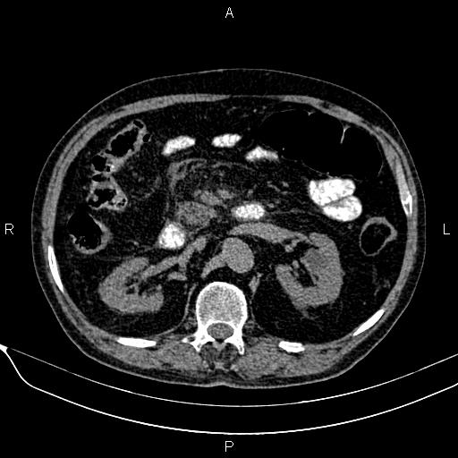 Acute pancreatitis (Radiopaedia 85146-100701 Axial non-contrast 52).jpg