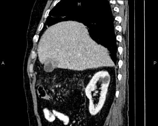 Acute pancreatitis (Radiopaedia 85146-100701 Sagittal C+ portal venous phase 22).jpg
