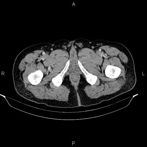 Acute pancreatitis (Radiopaedia 85390-101010 Axial C+ portal venous phase 118).jpg