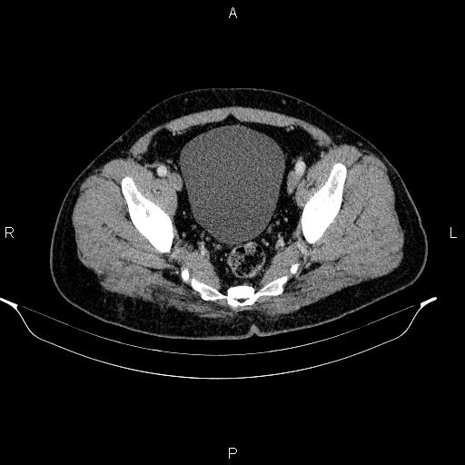 File:Acute pancreatitis (Radiopaedia 85390-101010 Axial C+ portal venous phase 94).jpg