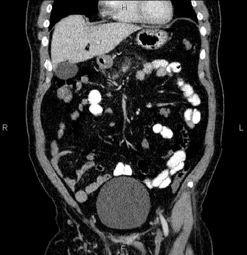 Acute pancreatitis (Radiopaedia 85390-101010 Coronal C+ portal venous phase 20).jpg