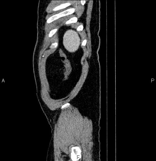 Acute pancreatitis (Radiopaedia 85390-101010 Sagittal C+ portal venous phase 100).jpg