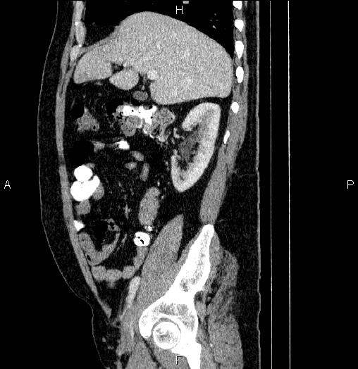 Acute pancreatitis (Radiopaedia 85390-101010 Sagittal C+ portal venous phase 29).jpg