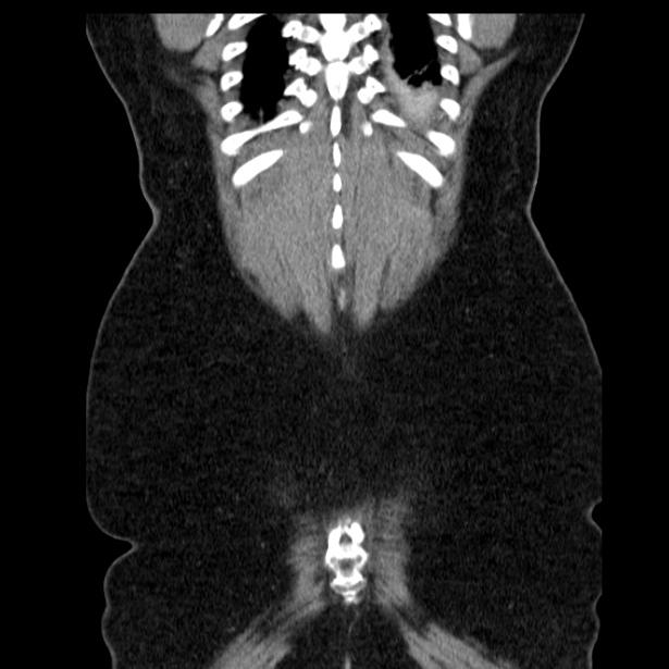 Acute pancreatitis - Balthazar C (Radiopaedia 26569-26714 Coronal C+ portal venous phase 62).jpg