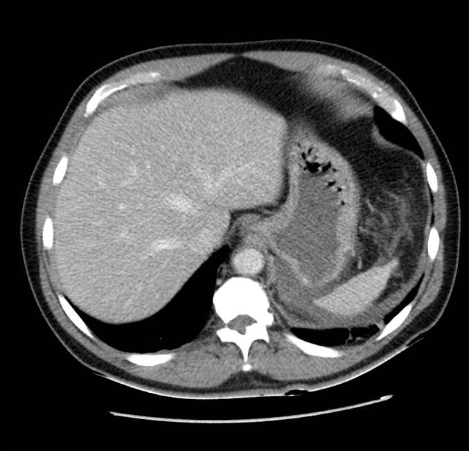 Acute pancreatitis - Balthazar E (Radiopaedia 23080-23110 Axial C+ portal venous phase 11).jpg