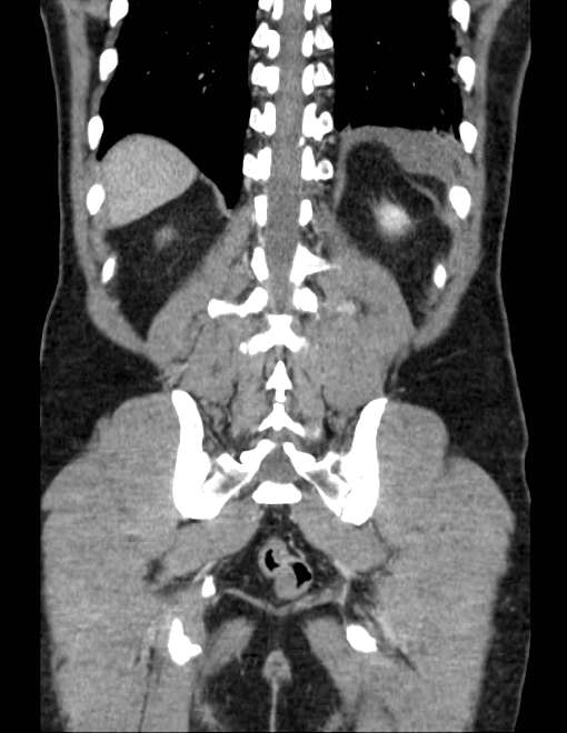 Acute pancreatitis - Balthazar E (Radiopaedia 23080-23110 Coronal C+ portal venous phase 65).jpg