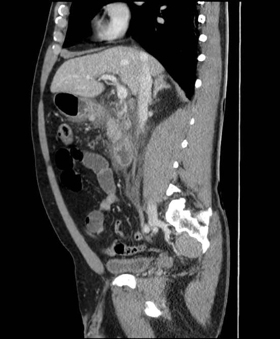 Acute pancreatitis - Balthazar E (Radiopaedia 23080-23110 Sagittal C+ portal venous phase 38).jpg