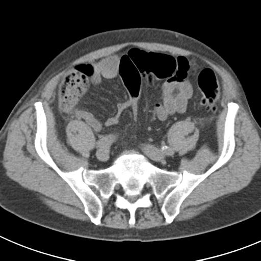 File:Acute pancreatitis and walled-off necrosis (Radiopaedia 29888-30403 Axial non-contrast 57).jpg