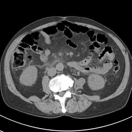 File:Acute pancreatitis and walled-off necrosis (Radiopaedia 29888-30404 Axial non-contrast 42).jpg
