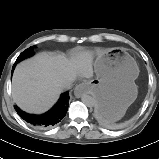 File:Acute pancreatitis and walled-off necrosis (Radiopaedia 29888-30404 Axial non-contrast 9).jpg