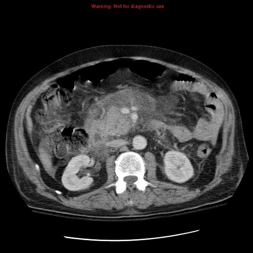 File:Acute pancreatitis with incidental pancreatic lipoma (Radiopaedia 10190-10730 Axial C+ portal venous phase 31).jpg