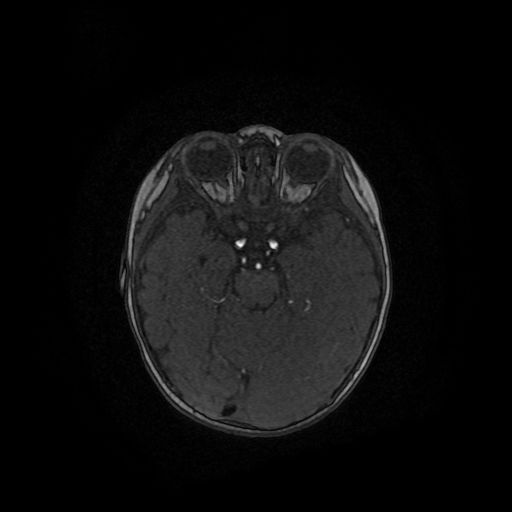 Acute phase of hemiconvulsion-hemiplegia epilepsy syndrome (Radiopaedia 29309-29745 Axial TOF angiography 88).jpg