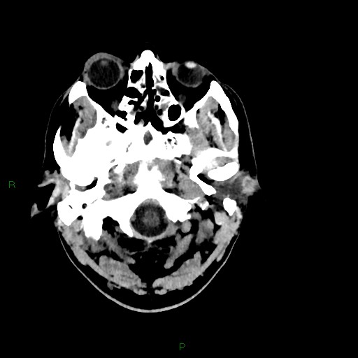 Acute posterior cerebral artery territory infarct (Radiopaedia 79329-92393 Axial non-contrast 11).jpg