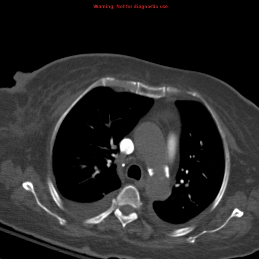 Acute pulmonary embolism (Radiopaedia 13286-13289 Axial C+ CTPA 25).jpg