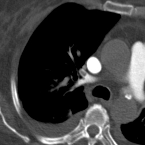 File:Acute pulmonary embolism (Radiopaedia 13286-13289 C 1).jpg