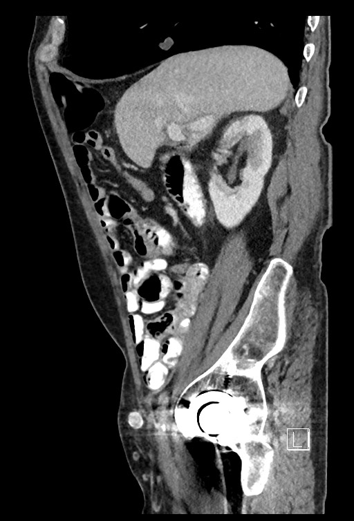 Acute renal infarction - rim capsular enhancement (Radiopaedia 59833-67270 Sagittal C+ portal venous phase 63).jpg