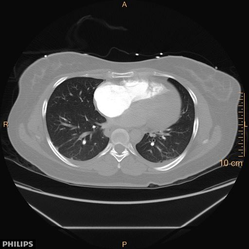 File:Acute reversible pulmonary hypertension and right heart failure from cocaine toxicity (Radiopaedia 49394-54517 Axial C+ CTPA 7).jpg