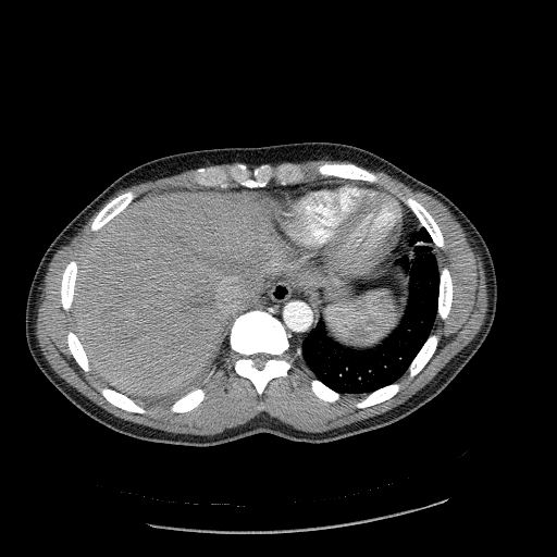 Acute segmental pulmonary emboli and pulmonary infarction (Radiopaedia 62264-70444 Axial C+ CTPA 94).jpg